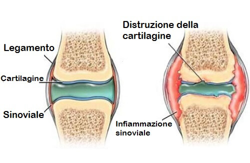 Come curare la cartilagine del ginocchio